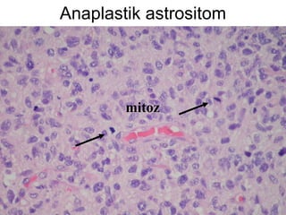 Anaplastik astrositom mitoz 