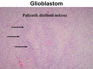 Glioblastom Palizatik dizilimli nekroz 