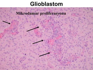 Glioblastom Mikrodamar proliferasyonu 