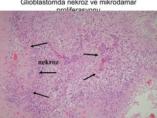 Glioblastomda nekroz ve mikrodamar proliferasyonu nekroz 