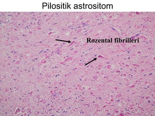 Pilositik astrositom Rozental fibrilleri 