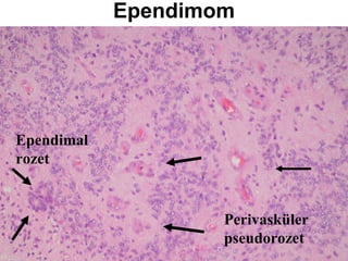 Ependimom Ependimal rozet Perivasküler pseudorozet 