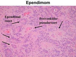 Ependimom Ependimal rozet Perivasküler pseudorozet 