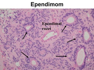 Ependimom Ependimal rozet 