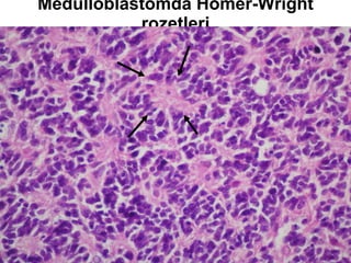 Medulloblastomda Homer-Wright rozetleri 
