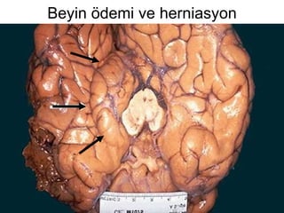 Beyin ödemi ve herniasyon 
