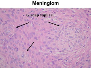 Meningiom Girdap yapıları 