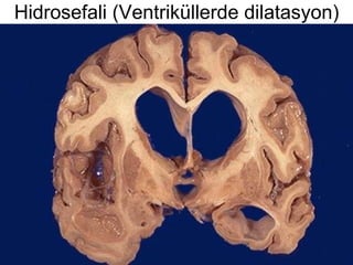 Hidrosefali (Ventriküllerde dilatasyon) 