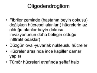 Oligodendrogliom Fibriler zeminde (hastanın beyin dokusu) değişken hücresel alanlar ( hücrelerin az olduğu alanlar beyin dokusu invazyonunun daha belirgin olduğu infltratif odaklar) Düzgün oval-yuvarlak nukleuslu hücreler Hücreler arasında ince kapiller damar yapısı Tümör hücreleri etrafında şeffaf halo 