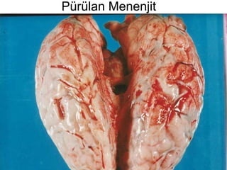 Pürülan Menenjit 