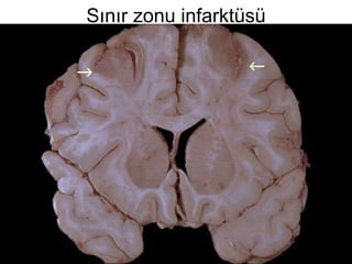 Sınır zonu infarktüsü   