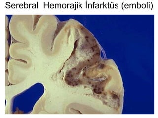 Serebral  Hemorajik İnfarktüs (emboli) 