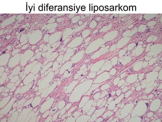 İyi diferansiye liposarkom 