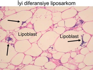 İyi diferansiye liposarkom Lipoblast Lipoblast 