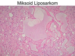 Miksoid Liposarkom 