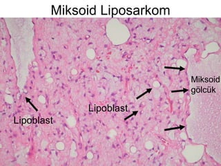 Miksoid Liposarkom Lipoblast Miksoid gölcük Lipoblast 