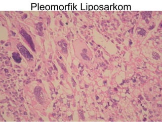 Pleomorfik Liposarkom 