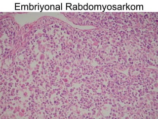 Embriyonal Rabdomyosarkom 