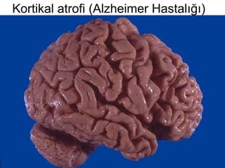 Kortikal atrofi   ( A lzheimer  H astalığı) 