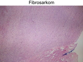 Fibrosarkom 