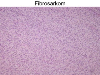 Fibrosarkom 