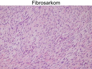 Fibrosarkom 