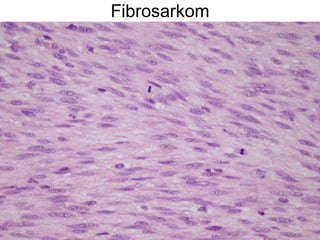 Fibrosarkom 