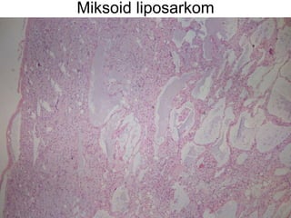 Miksoid liposarkom 