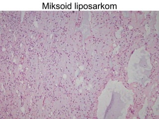 Miksoid liposarkom 