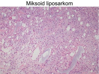 Miksoid liposarkom 