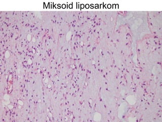 Miksoid liposarkom 