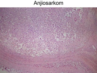 Anjiosarkom 