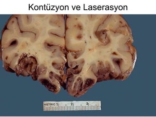 Kontüzyon ve Laserasyon 