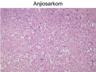 Anjiosarkom 