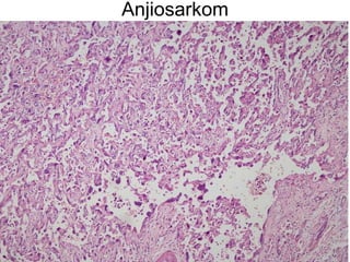 Anjiosarkom 