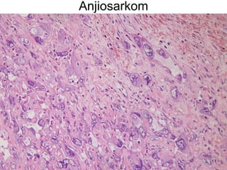 Anjiosarkom 