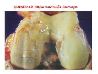 DEJENERATİF EKLEM HASTALIĞI-Eburnasyon 