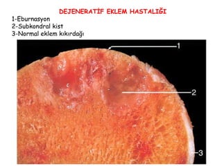 DEJENERATİF EKLEM HASTALIĞI 1-Eburnasyon 2-Subkondral kist 3-Normal eklem kıkırdağı 