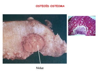 OSTEOİD OSTEOMA Nidus 