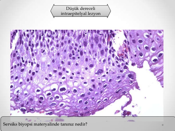 Endometrioz nedir Endometrioz nedir