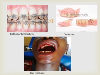 
Jaw fractures
Orthodontic brackets Dentures
 