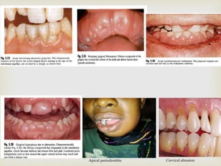 
Cervical abrasionApical periodontitis
 