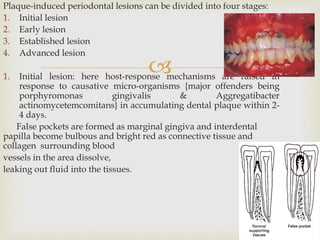 
Plaque-induced periodontal lesions can be divided into four stages:
1. Initial lesion
2. Early lesion
3. Established lesion
4. Advanced lesion
1. Initial lesion: here host-response mechanisms are raised in
response to causative micro-organisms {major offenders being
porphyromonas gingivalis & Aggregatibacter
actinomycetemcomitans} in accumulating dental plaque within 2-
4 days.
False pockets are formed as marginal gingiva and interdental
papilla become bulbous and bright red as connective tissue and
collagen surrounding blood
vessels in the area dissolve,
leaking out fluid into the tissues.
 