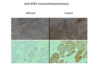 ControlAffected
Anti-RYR1 immunohistochemistry
 