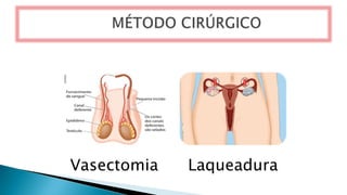 Vasectomia Laqueadura
 