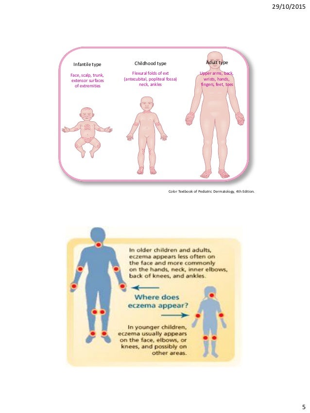 disease skin treatment diagnosis and 4th edition Management Essential in Component Eczema Moisturizers An