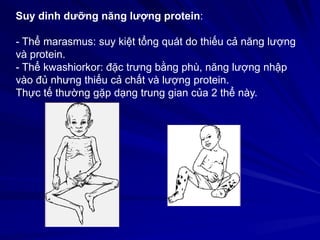 Suy dinh dưỡng năng lượng protein:
- Thể marasmus: suy kiệt tổng quát do thiếu cả năng lượng
và protein.
- Thể kwashiorkor: đặc trưng bằng phù, năng lượng nhập
vào đủ nhưng thiếu cả chất và lượng protein.
Thực tế thường gặp dạng trung gian của 2 thể này.
 