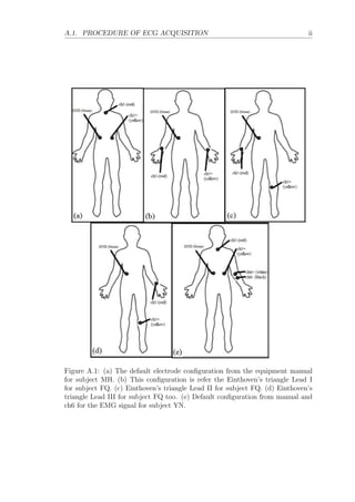 A.1. PROCEDURE OF ECG ACQUISITION ii
Figure A.1: (a) The default electrode conﬁguration from the equipment manual
for subject MH. (b) This conﬁguration is refer the Einthoven’s triangle Lead I
for subject FQ. (c) Einthoven’s triangle Lead II for subject FQ. (d) Einthoven’s
triangle Lead III for subject FQ too. (e) Default conﬁguration from manual and
ch6 for the EMG signal for subject YN.
 