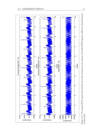 A.2. EXPERIMENT RESULT vi
FigureA.4:YNoriginalECGsignaluseddefaultelectrodesettingfromthemanualandaddedEMGsignalindiﬀerentchannelshowed
inthirdplot.
 