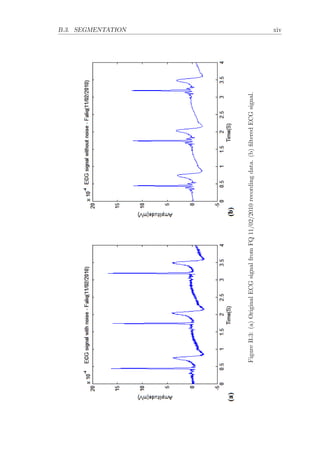 B.3. SEGMENTATION xiv
FigureB.3:(a)OriginalECGsignalfromFQ11/02/2010recordingdata.(b)ﬁlteredECGsignal.
 